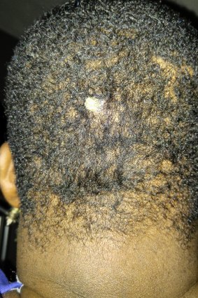 A bullet remains lodged in the back of Jay Wilson's head.