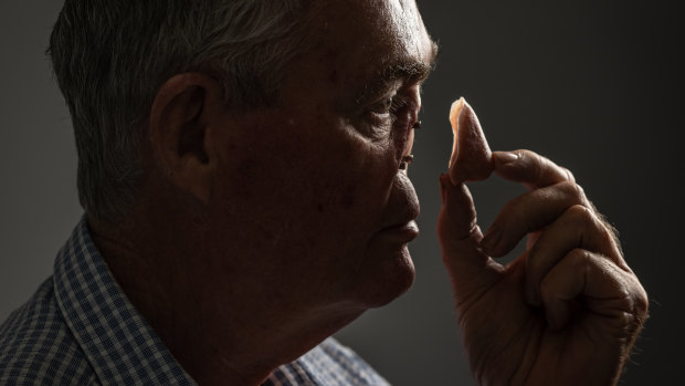 Cancer ravaged Mark’s nose. Doctors used 3D printing to make a new one
