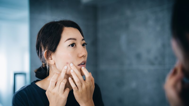 Zdravljenje aken pri odraslih zahteva drugačen pristop kot pri najstnikih