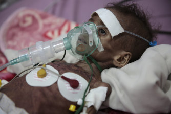 A malnourished girl, Rahmah Watheeq, receives treatment at a feeding centre at Al-Sabeen hospital in Sanaa earlier this month. Two in three Yemeni are hungry.