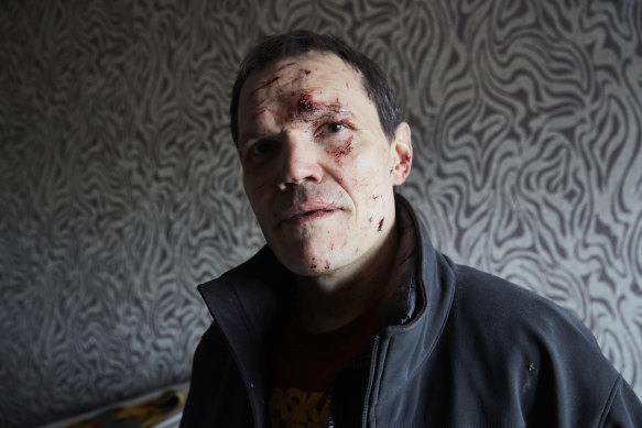 Vladimir in his bedroom in Kyiv on February 25, 2022. He was wounded on his face by an exploding window. at the start of Russia’s invasion of Ukraine a day earlier. 