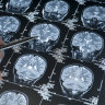 Experimental Alzheimer’s drug slows cognitive decline in trial, firms say