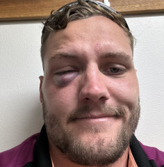 Eye sore: Ethan O’Neill after the incident