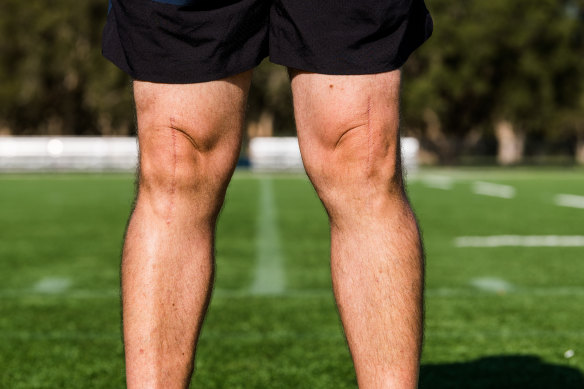 Thomas Mitsios’ knees, showing the scars from a double knee replacement.