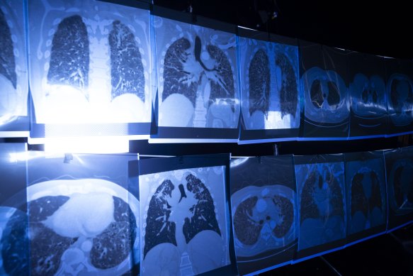 X-rays showing the effects of silicosis on the lungs.