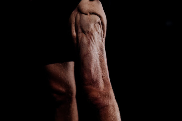 Three quarters of Connellan's quadriceps muscle was ripped from the bone.