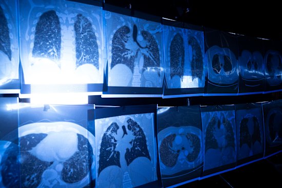 X-rays showing the effects of silicosis.