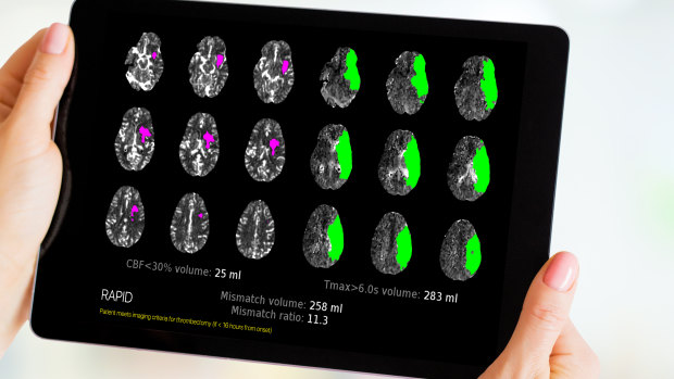 The scan shows regions of the brain already affected by stroke (pink) and those that remain at risk (green). 