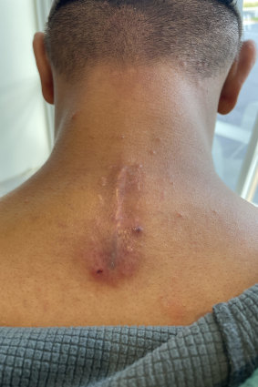 Junior Tatola shows off the scar on his neck