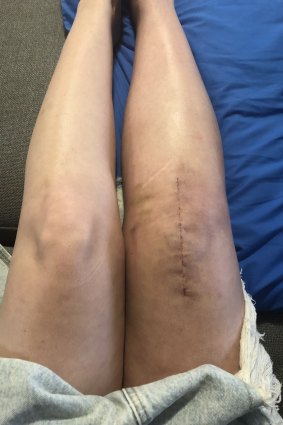 Brisbane woman Linda Wilson suffered a broken kneecap after allegedly being struck by an e-scooter in June.