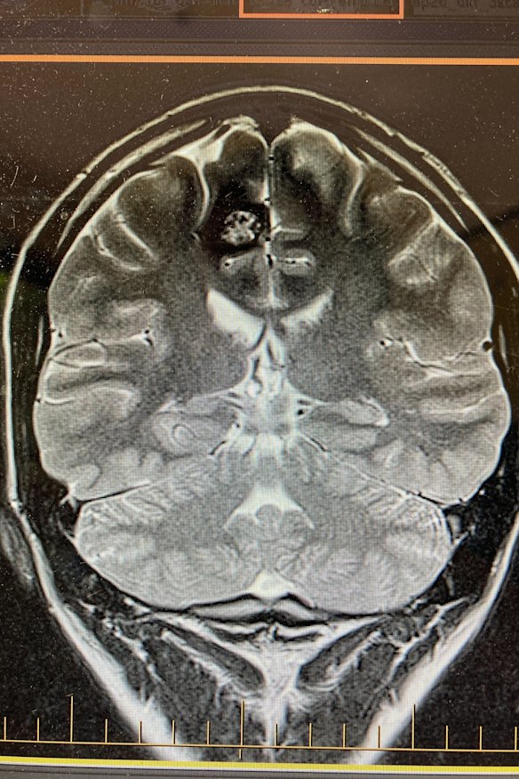 A scan of Angus Thomson’s brain showing the cavernoma at top left, which was causing his hand to shake uncontrollably.