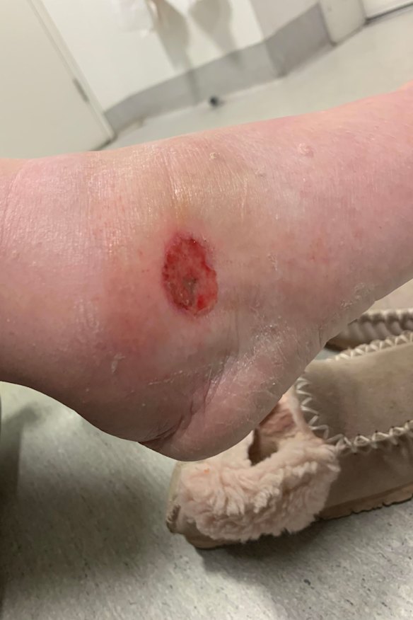 An early-stage Buruli ulcer. 