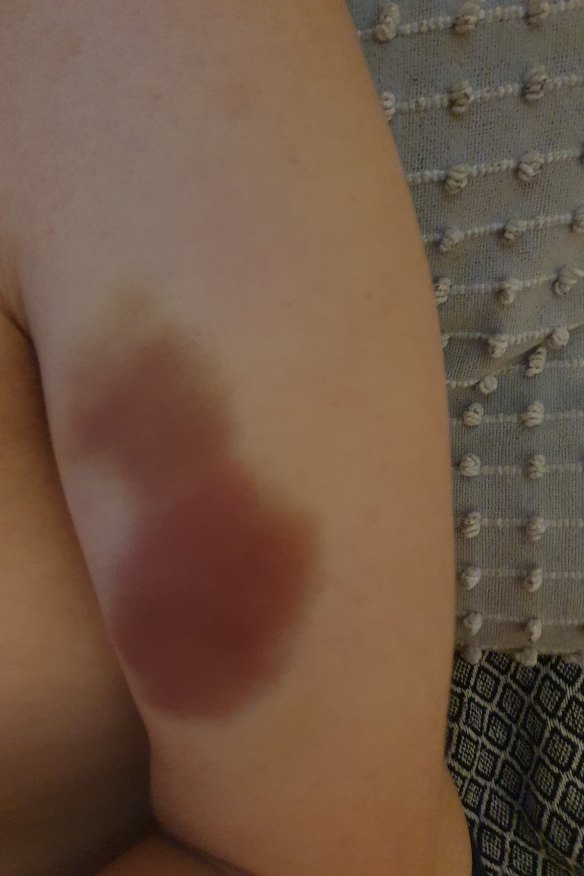 Anndrea Wheatley is calling for mandatory CCTV in places of care for people with a disability after her son suffered unexplained injuries while in care. 