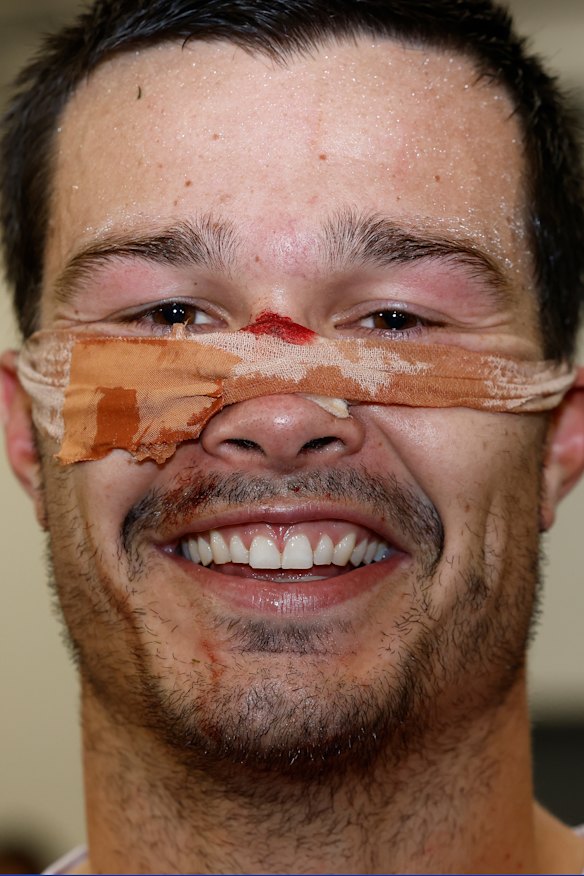 Silvagni looked worse for wear after Sunday night’s win.