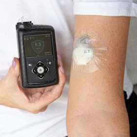 Diabetes medical staff are struggling to keep up with an explosion in people seeking wearable diabetes glucose monitoring and insulin pumps.