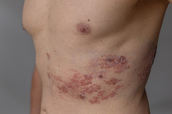 Shingles (herpes zoster) can be quite painful, but studies have found that the vaccine is associated with a lower risk of developing dementia or heart problems.