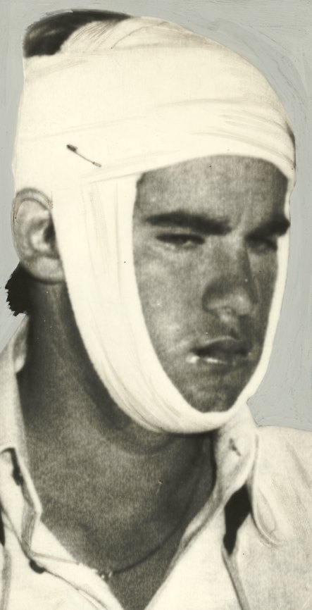 David Hookes sustained a fractured jaw in 1977. 