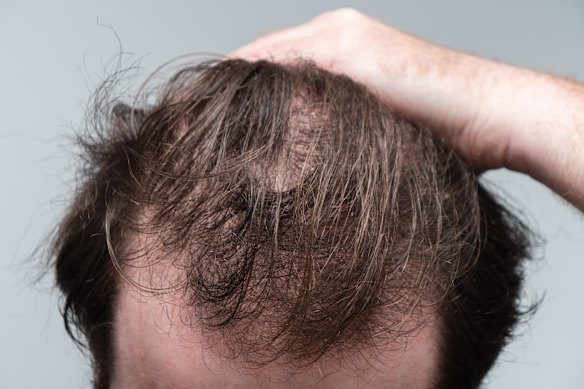 The first stages of male pattern baldness include bald patches and thinning hair. Finasteride and minoxidil are the two key treatments.