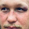Reuben Cotter was left with a nasty bump above his left eye