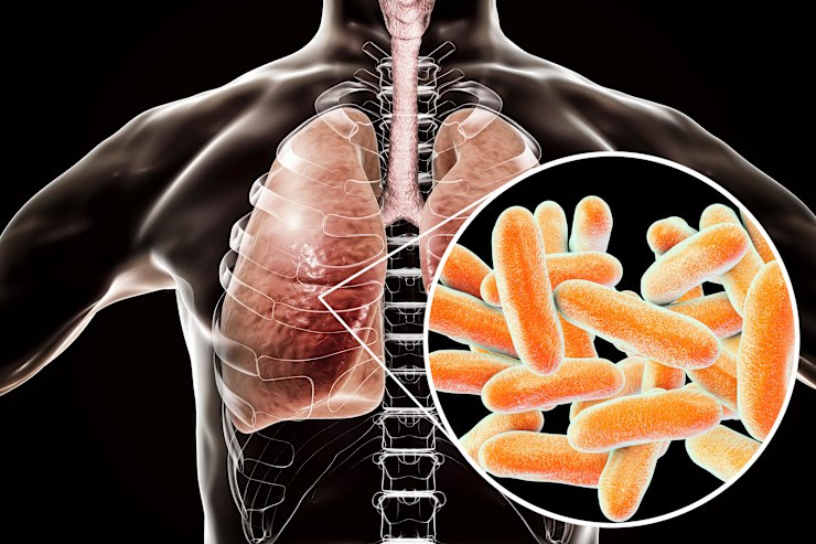Legionnaires’ disease can lead to potentially fatal pneumonic lung damage in vulnerable patients.