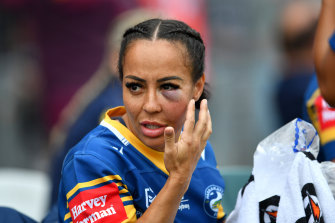Bruising: Therese Aiton sports an impressive shiner during the Eels’ clash against Newcastle.