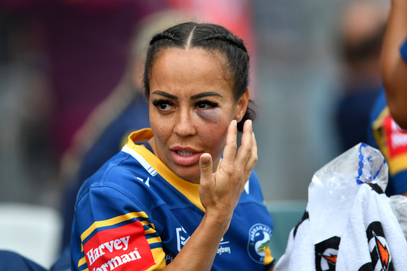 Bruising: Therese Aiton sports an impressive shiner during the Eels’ clash against Newcastle.