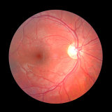 An example of a retinal photograph used in the study. The bright circle is the retina, and within that is a smaller circle that a specialist, or an AI program, must assess for glaucoma risk.