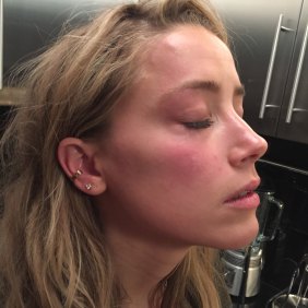A photo used in evidence of Amber Heard with marks on her face that she says were inflicted by Johnny Depp in May 2016