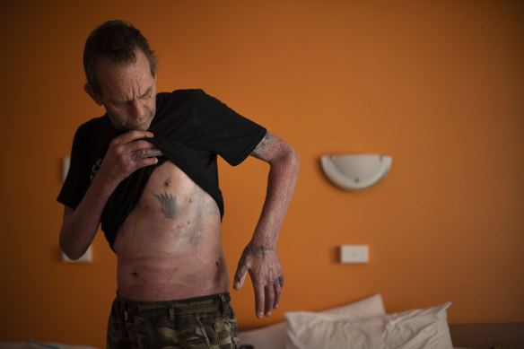 Like patchwork: Roy Annesley's life-saving grafts have left remnants of old tattoos from his shoulder and ribs on his hands and fingers.