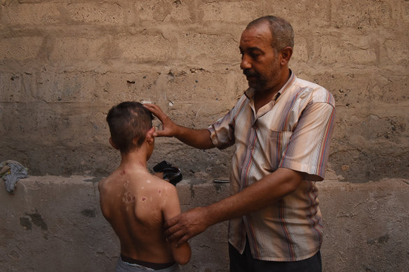 Nadhm Hamid shows the scars on his 11-year-old son, Yaser, which were caused by a chemical weapon that came through the roof of their home in Mosul.