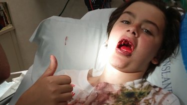 Codie Walton lost three front teeth in an accident at a trampoline park.