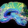 The Australian research (and brains) that led to a new schizophrenia drug