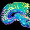 A new scan could detect Alzheimer’s earlier.
