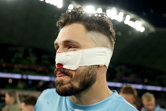 City’s Mathew Leckie with his nose injury.