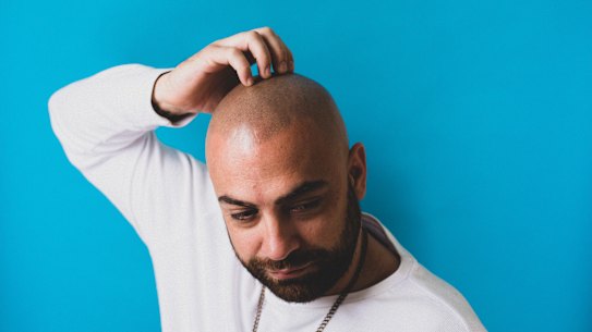 Sydney man Gray Roberts has had thousands of dots of pigment tattooed on his scalp to resemble hair follicles.