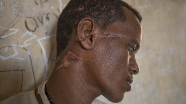 Ethnic Tigrayan survivor Abrahaley Minasbo, 22, from Mai-Kadra, Ethiopia, shows his wounds from machetes, inside a shelter, near the Sudan-Ethiopia border.