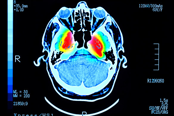 A scan of a brain with Parkinson’s disease. 