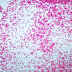 Abundant meningococci bacteria observed, with a notably absence of white blood cells in the spinal fluid from a critically ill meningitis patient.