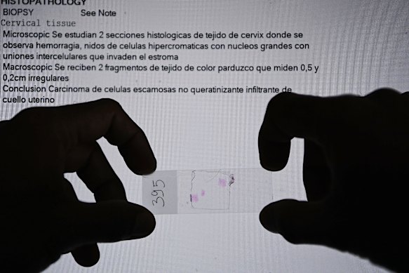 Guido Valadares National Hospital histopathology laboratory unit technician Nelson Tonito Marcal Sequeira holds a patient’s cervical cancer sample. 
