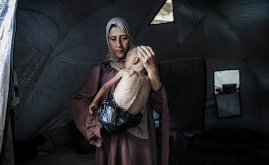 Muhammad Zakariya Ayyoub al-Matouq, aged one and a half, facing life-threatening malnutrition at a tent city in Gaza City on Monday this week.