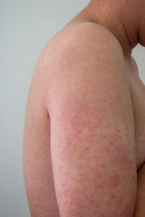 The rubella rash - scenes such as this are now incredibly rare in Australia.