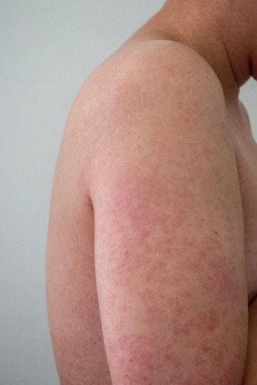 The measles rash.