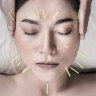 Acupuncture for wrinkles? Here’s what you need to know