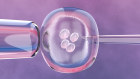 Women in NSW undergoing IVF and accessing other assisted
reproductive technologies will be given a cash rebate of up to $2,000 to reduce treatment costs