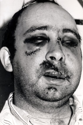 The infamous picture of Labor MP Peter Baldwin in Royal Prince Alfred Hospital recovering from a bashing., the victim of a vicious branch-stacking war.