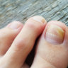 The dodgy nail salon practices fuelling a surge in fungal infections