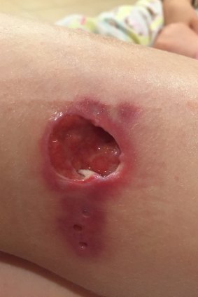 A Buruli ulcer on the leg of a Victorian primary school student.