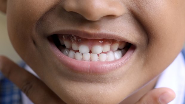 Tooth decay is on the rise in young children.
