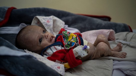 Mohammed, 4, lies on a bed in the Indira Gandhi hospital in Kabul, Afghanistan on Monday.