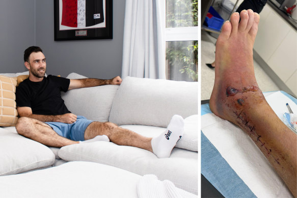 Australian cricketer Glenn Maxwell relaxes at home, and (right) his badly injured left foot.